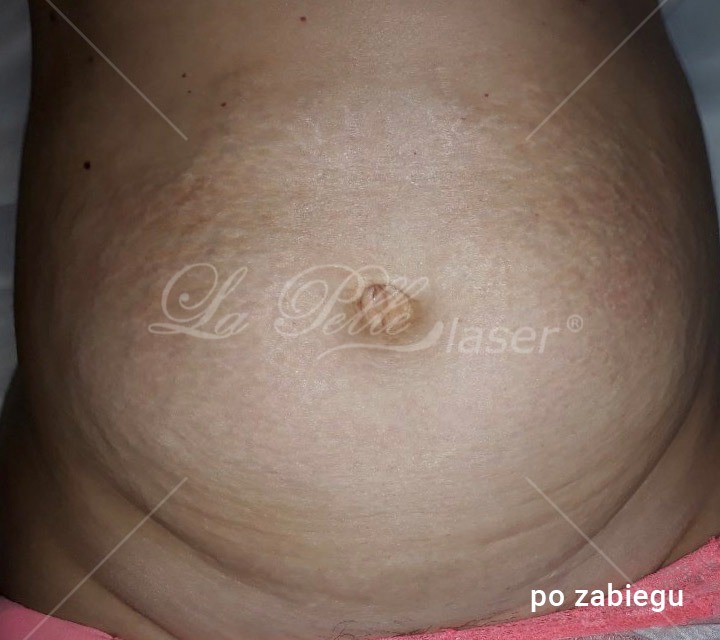 Redukcja wiotkiej skóry - Cutera Titan - Szablon Revitall