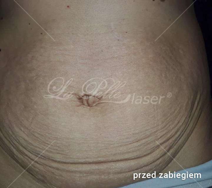 Redukcja wiotkiej skóry - Cutera Titan - Szablon Revitall